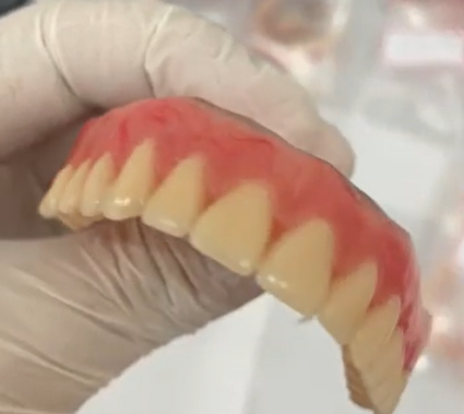 🦷 Sorriso Renovado: G Carvalho Soluções transforma vidas com próteses dentárias!